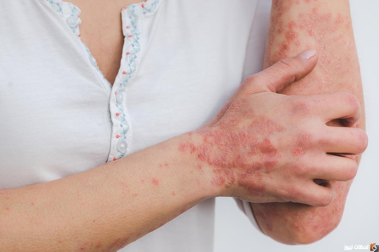 من هنا.. طرق طبيعية بالأعشاب لعلاج مرض الصدفية