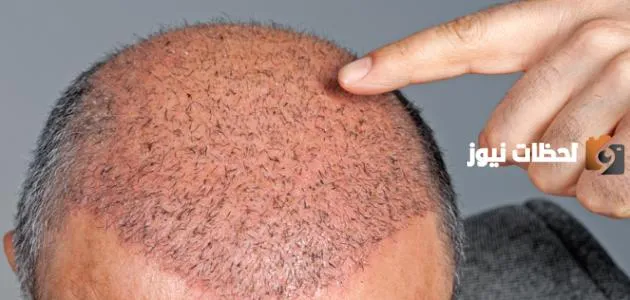 ما حكم زراعة الشعر