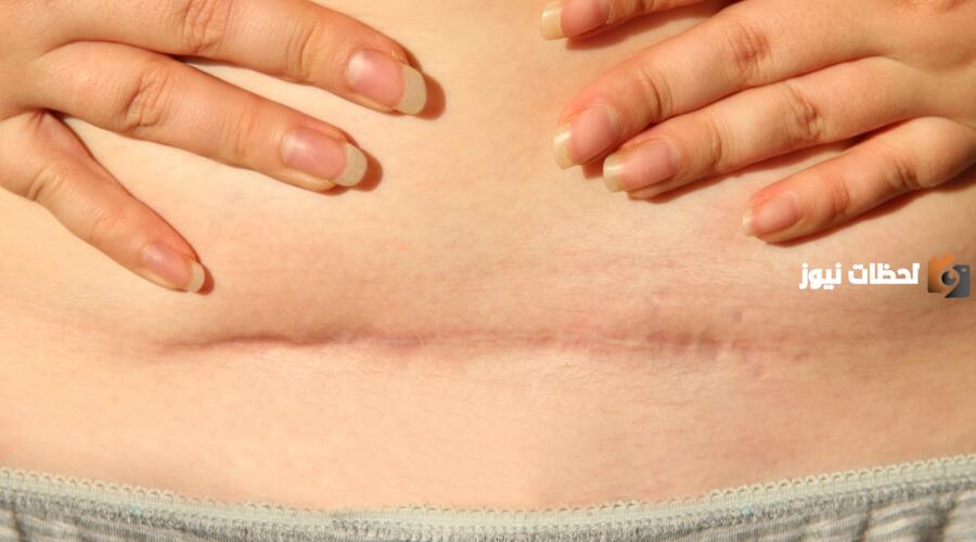 علامات شفاء جرح الولادة