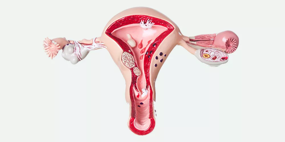 ما سبب ظهور حبة في عنق الرحم