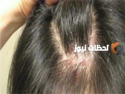 تفسير حلم بقع حمراء في الرأس