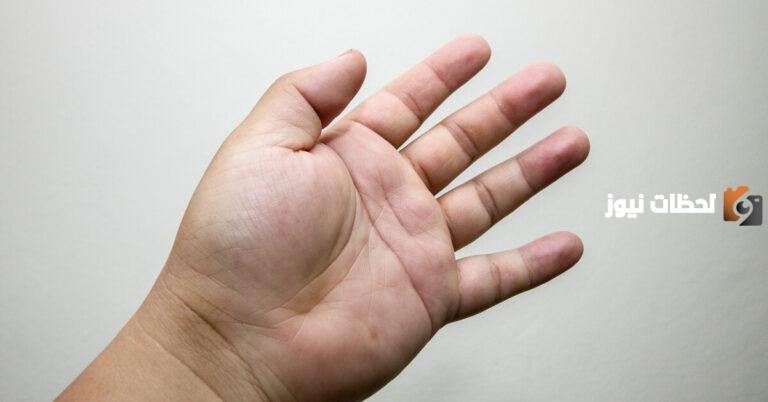 ما دلالات انتفاخ اليدين لمرضى السكري؟