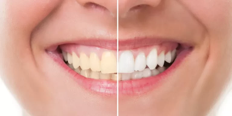 متى آكل بعد تبييض الأسنان بالليزر؟