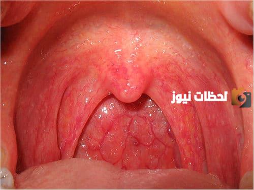 هل قطع الزجاج تتحلل بالمعدة