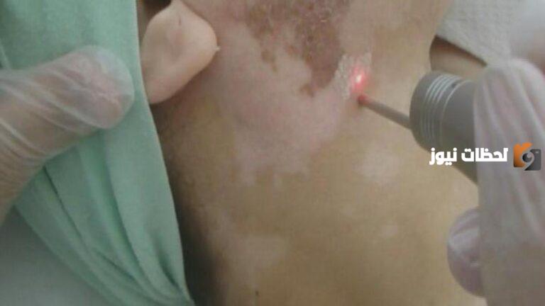 هل يؤثر إزالة الشعر بالليزر على البهاق؟