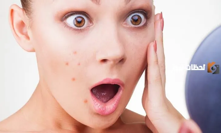 علاج حب الشباب طبيعياً