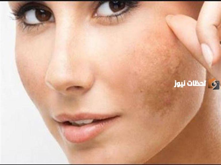 إزالة البقع من الوجه في يوم