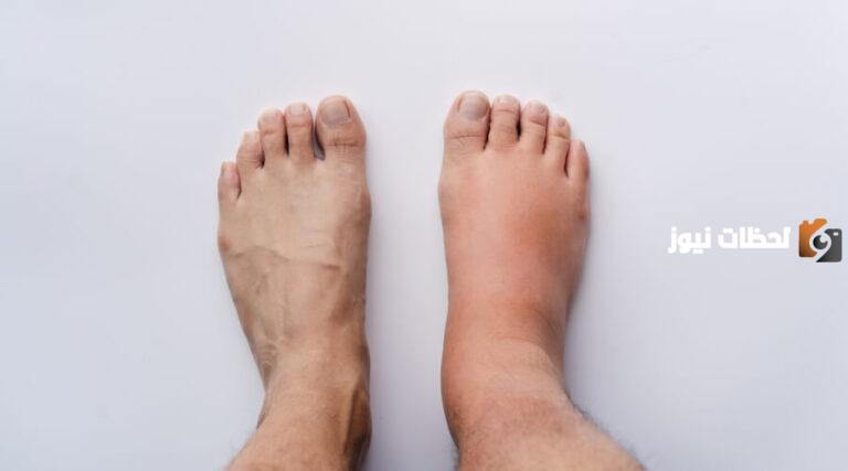 ما سبب انتفاخ القدم اليمنى بدون ألم