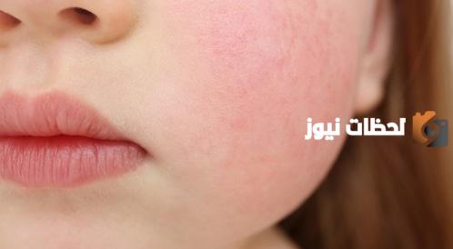 ما هو المرض الخامس لدى الاطفال