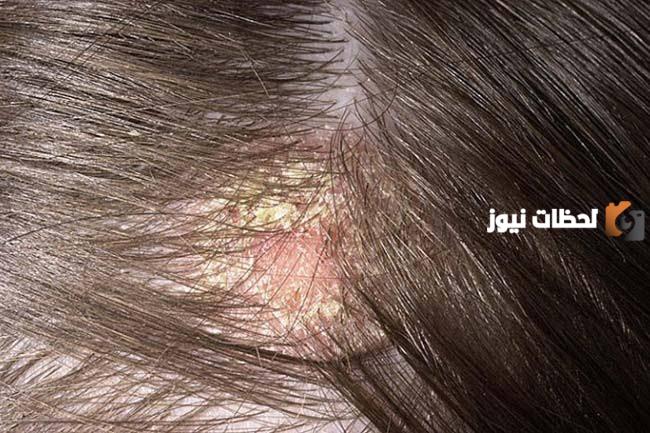 ما هي أسباب قشرة الرأس عند الأطفال