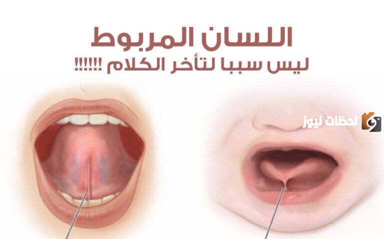 ما هي مشكلة اللسان المربوط عند الأطفال