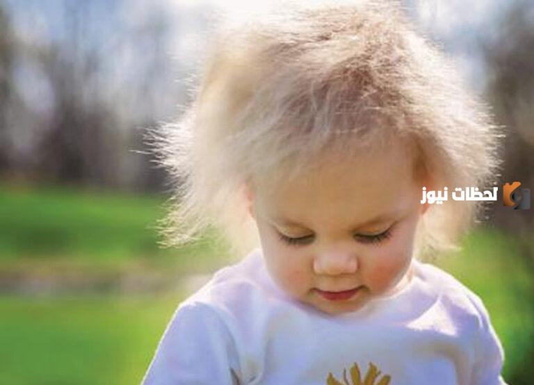 متلازمة أينشتاين عند الأطفال