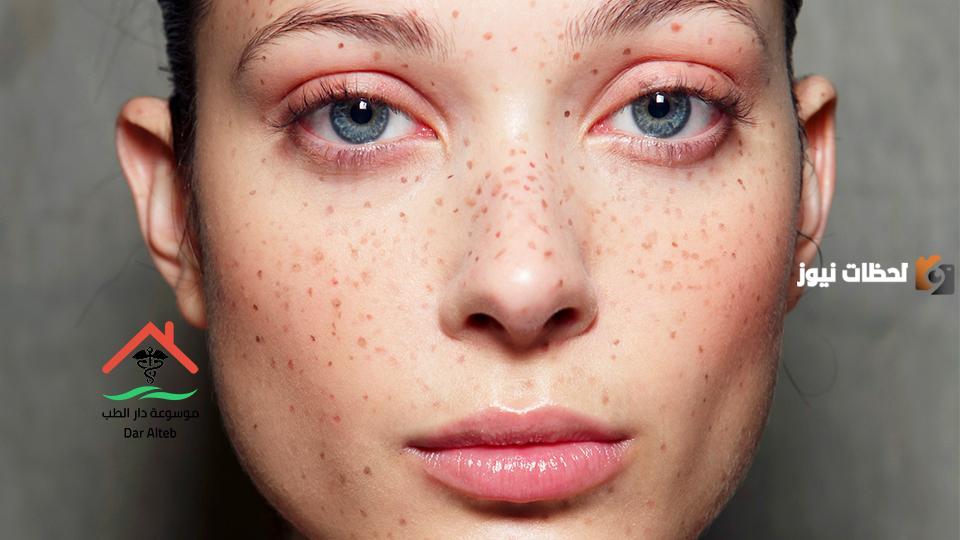 علاج النمش نهائياً بالأعشاب بوصفات آمنة وفعالة