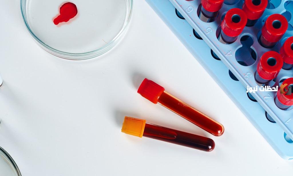 ما هو تحليل RDW-CV وعلى ماذا يدل ارتفاع وإنخفاض نتيجته