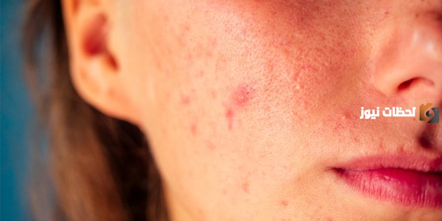 ما هي طرق التخلص من حفر حب الشباب