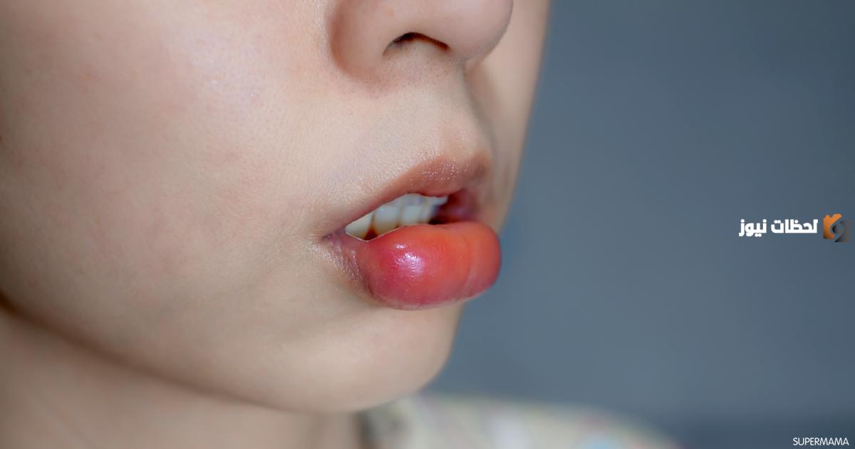 ما هي وصفات علاج التهاب الشفايف من الخارج في المنزل