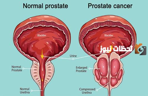 أعراض سرطان البروستاتا