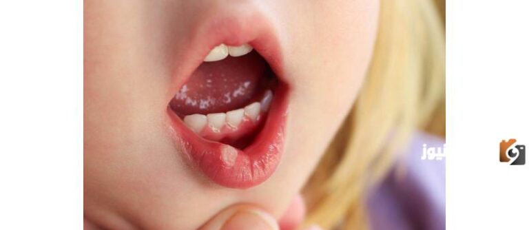 أسباب مرض القلاع عند الأطفال