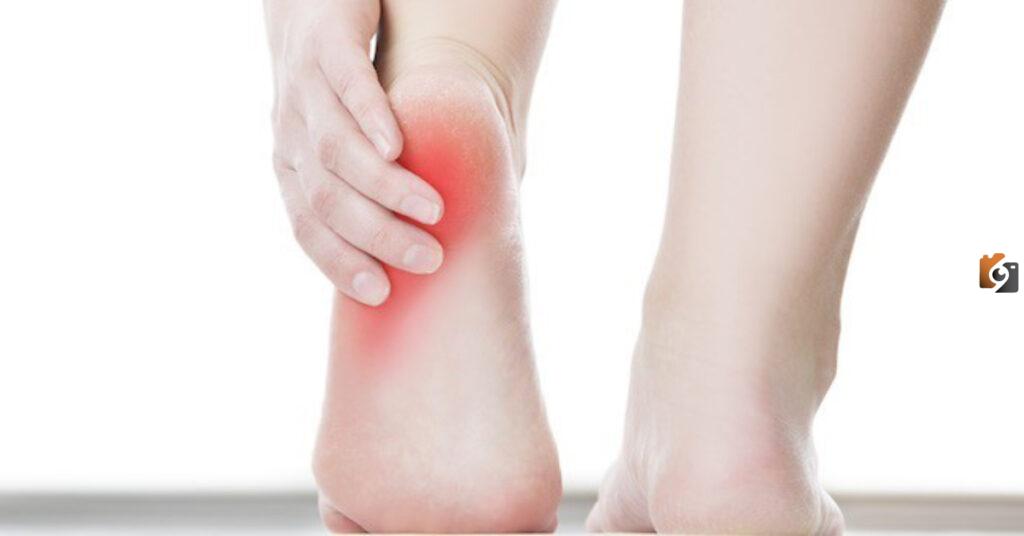 علاج القدم المسطحة Flat feet