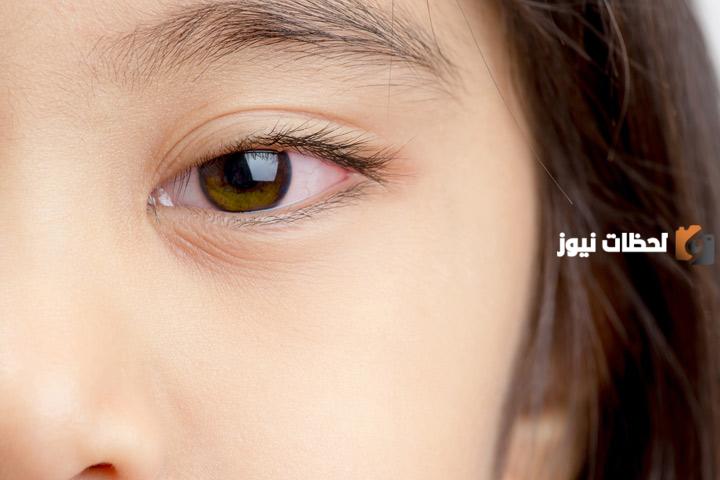 ما هو علاج خدش القرنية عند الأطفال