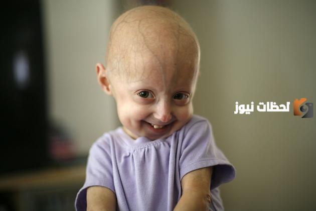ما هو مرض البروجيريا عند الأطفال