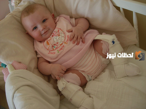 ما هي أسباب و علامات مرض خلع الورك الولادي