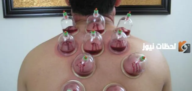 هل نهى الرسول عن الحجامة في رمضان؟