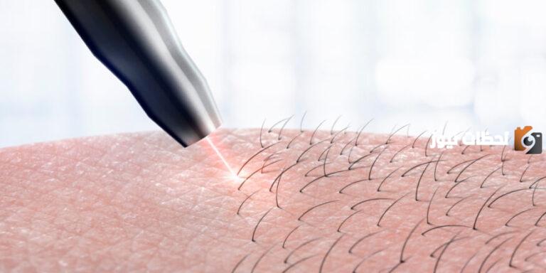 إليك مميزات وعيوب إزالة الشعر بالليزر
