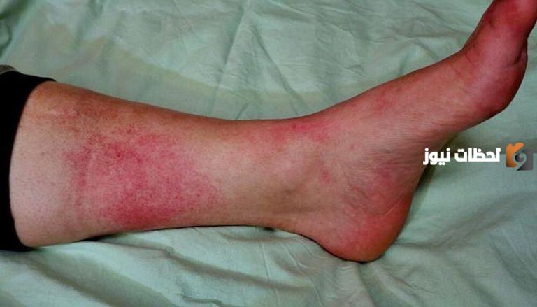 جميع  طرق علاج مرض الحمرة بالساق