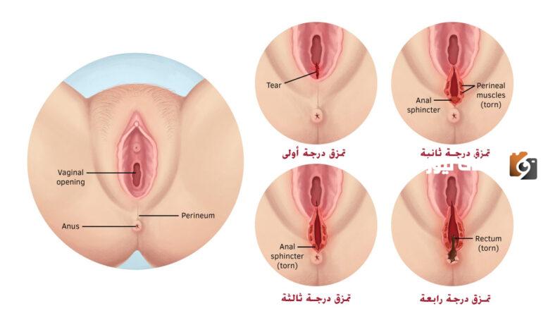 طريقة تضييق المهبل بعد الولادة