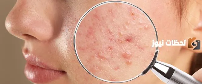 ما هو علاج ندبات حب الشباب بخلطات طبيعية