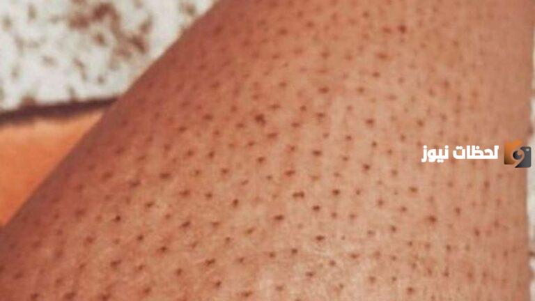 ما هو علاج نمو الشعر تحت الجلد فى الساقين
