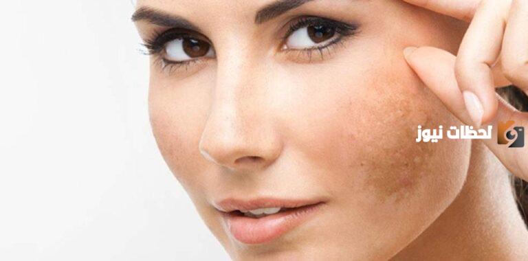وصفات لعلاج الكلف والنمش