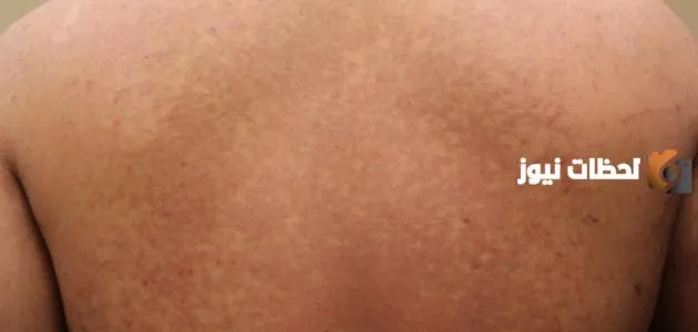 أسباب ظهور نقط سوداء على الجلد