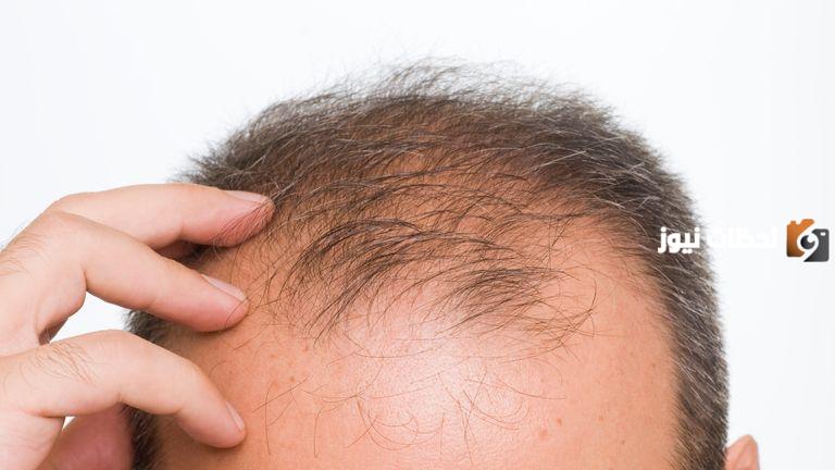 تعرف على أفضل أدوية لعلاج الصلع عند النساء والرجال بالتفاصيل