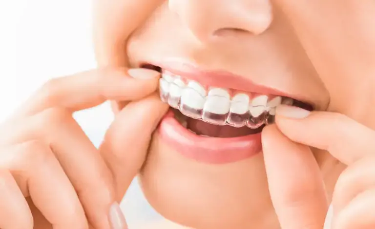 تقويم الاسنان الشفاف