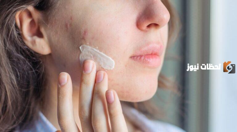 طرق علاج حب الشباب طبيعية وسريعة نهائياً من المنزل