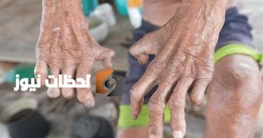 وزارة الصحة تقدم علاج الجذام مجانًا في عيادات الجلدية المتخصصة بجميع المحافظات
