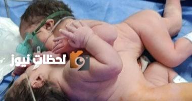 ولادة توأم ملتصق نادر في مستشفى الفيوم العام (صور)