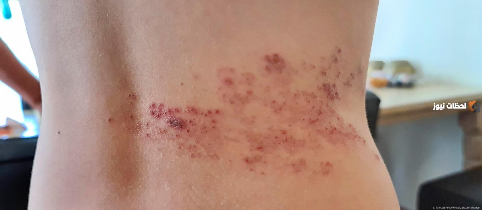 النقاط الحمراء الصغيرة على البشرة هل تكون مؤشر خطر